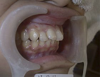 e.maxプレス治療前